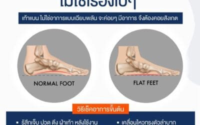 เรื่องเท้าแบน ไม่ใช่เรื่องเบ ๆ